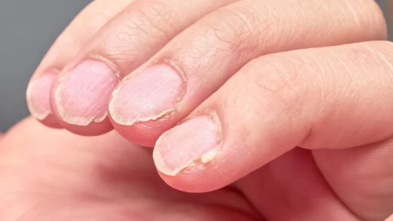 Estão danificando as suas unhas: 3 motivos para o enfraquecimento e como reverter