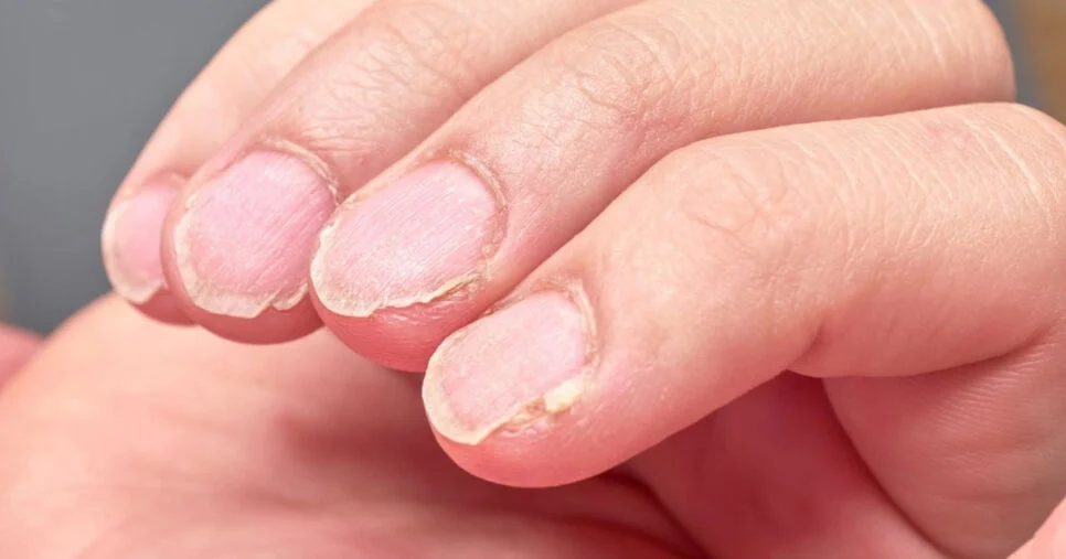Estão danificando as suas unhas: 3 motivos para o enfraquecimento e como reverter